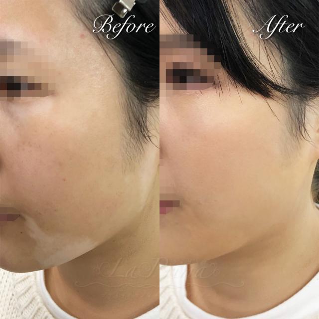 アザ・白斑・太田母斑などのカバーメイクモデル