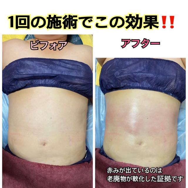 初回限定💖2月末まで🌕ダイエットしたい!肩こり、お腹、二の腕など部分痩せしたい!男女募集‼️
