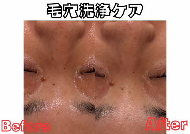 平日限定!
フェイシャルエステ【首から上】
毛穴洗浄ケア付き!