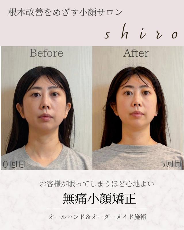 小顔矯正のビフォーアフターの掲載をさせていただける方