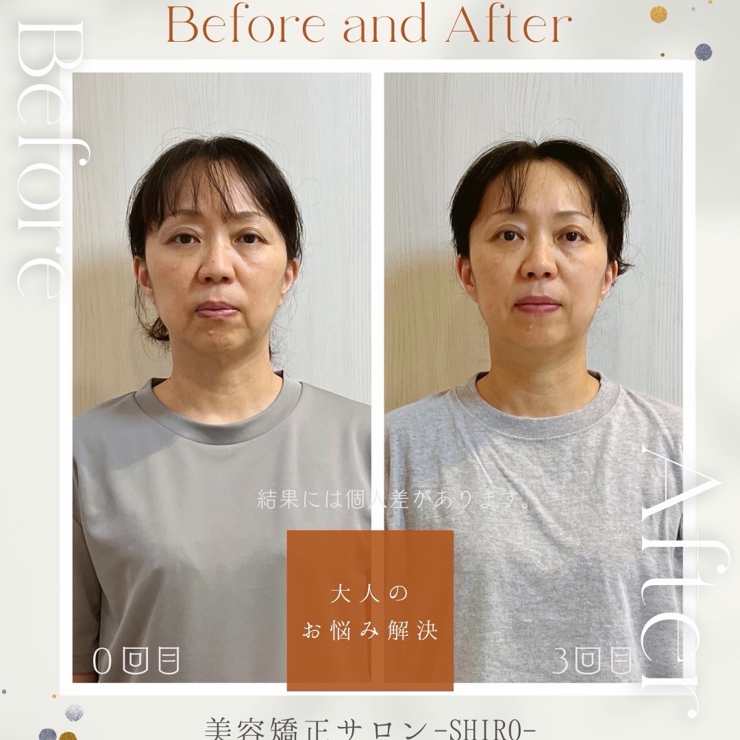 小顔矯正のビフォーアフターの掲載をさせていただける方