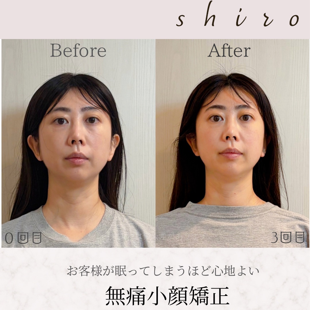 小顔矯正のビフォーアフターの掲載をさせていただける方